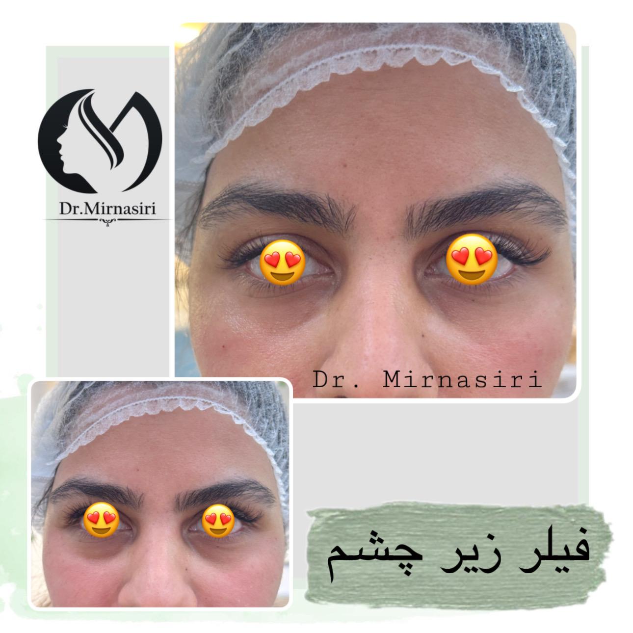 فیلر زیر چشم