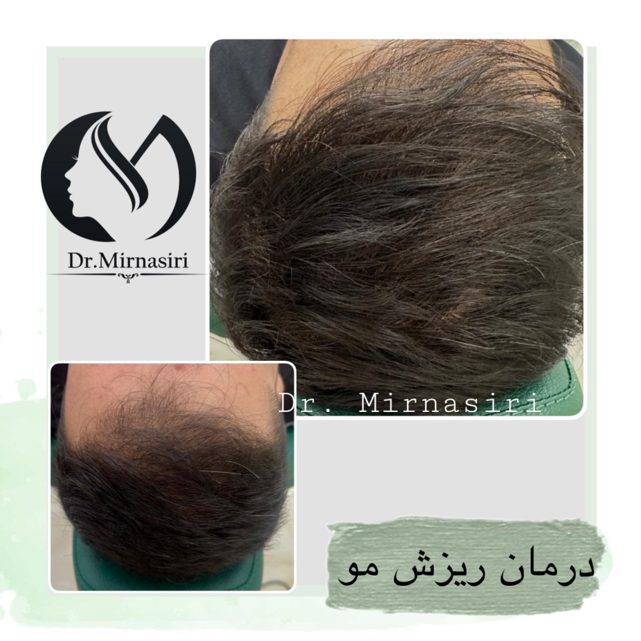 درمان ریزش مو