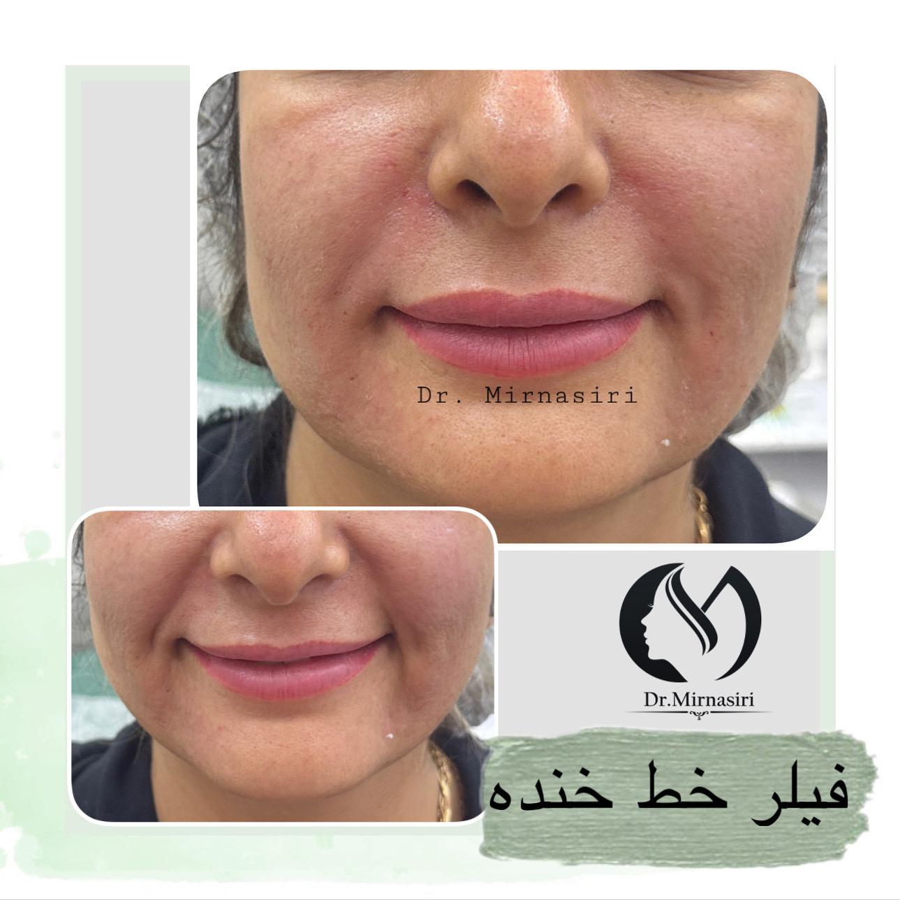 فیلر خط خنده