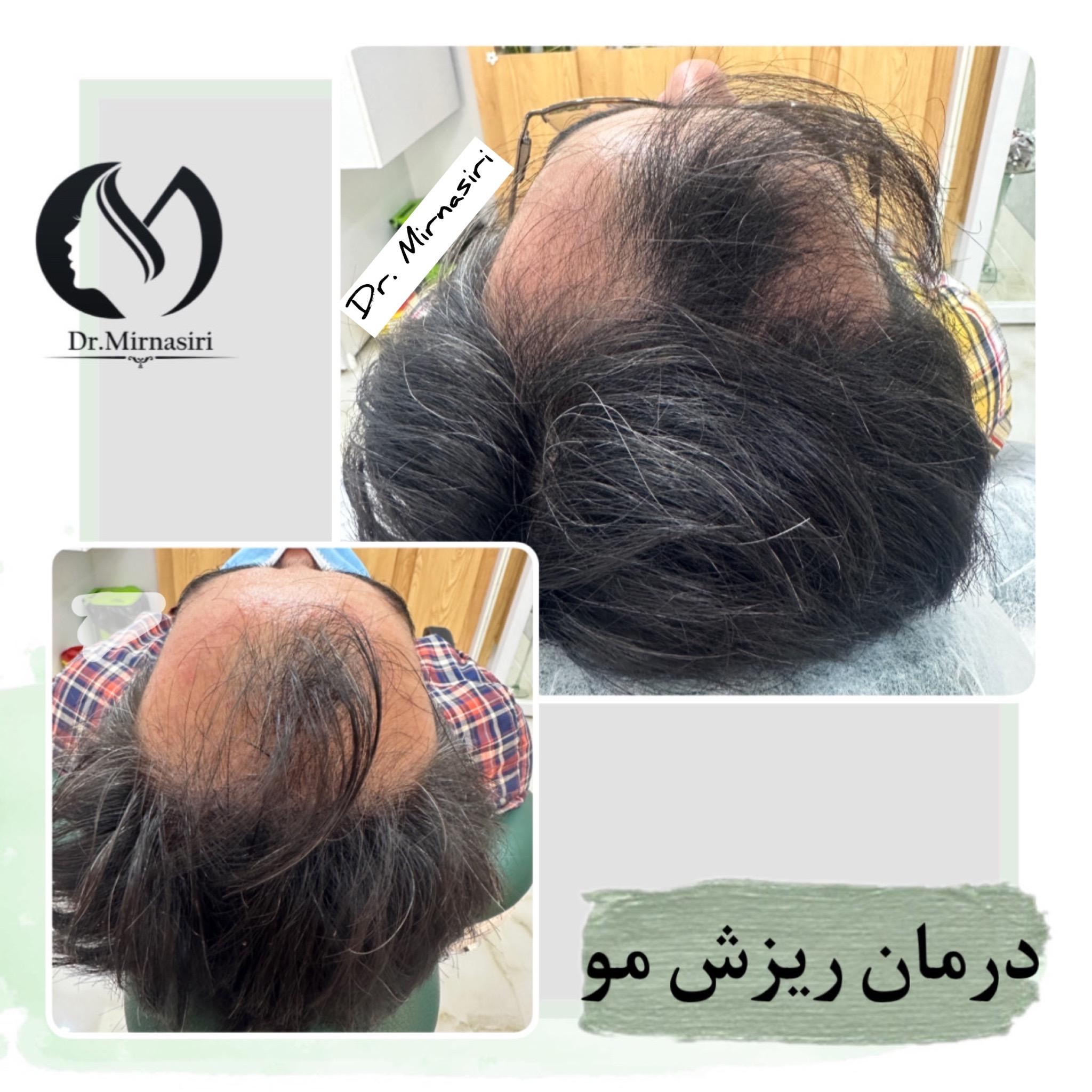 درمان ریزش مو