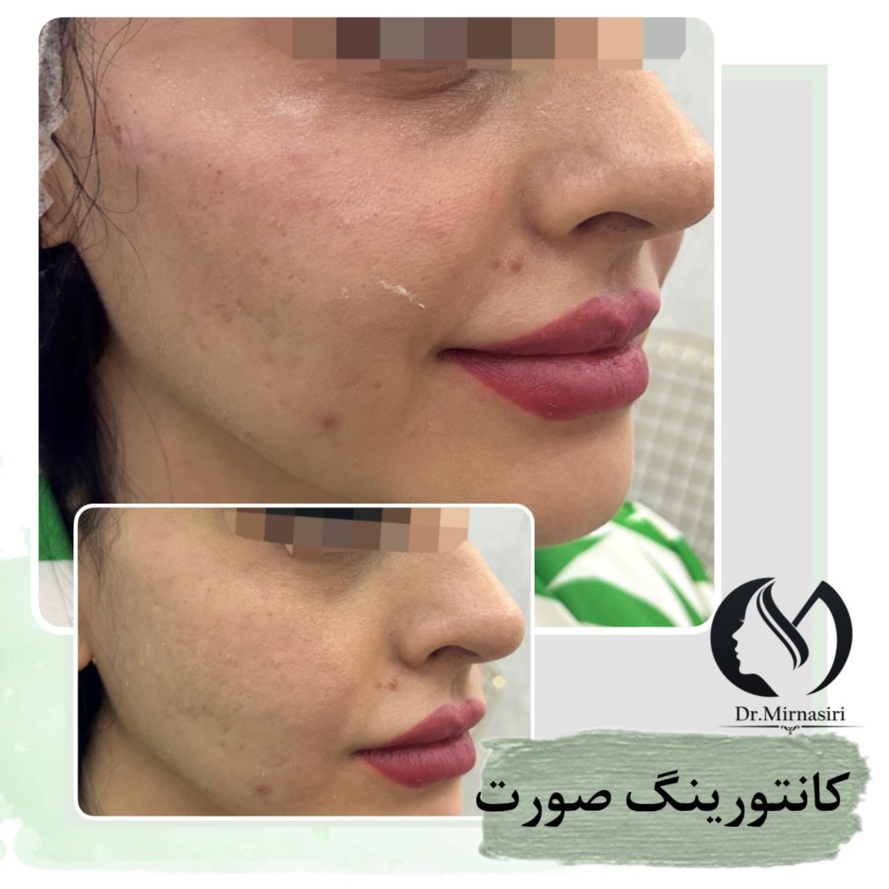 کانتورینگ صورت