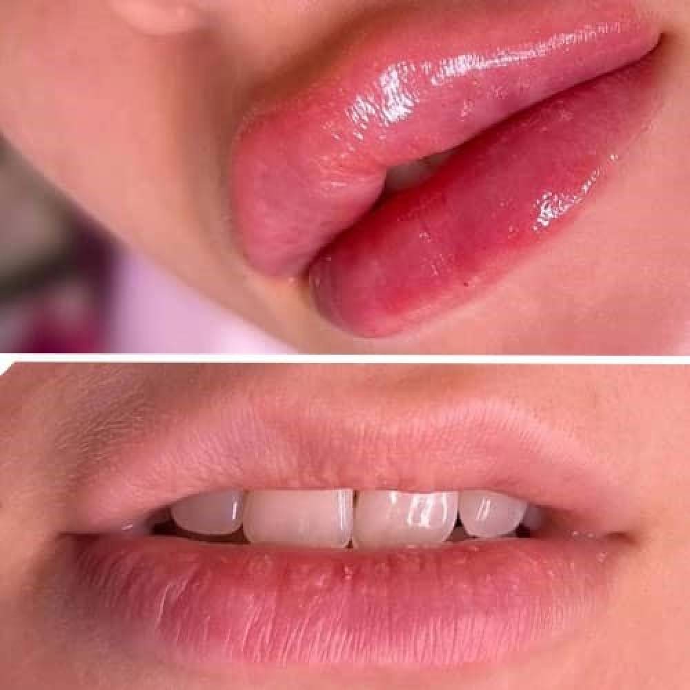 درباره تزریق ژل لب طبیعی و روسی در اصفهان