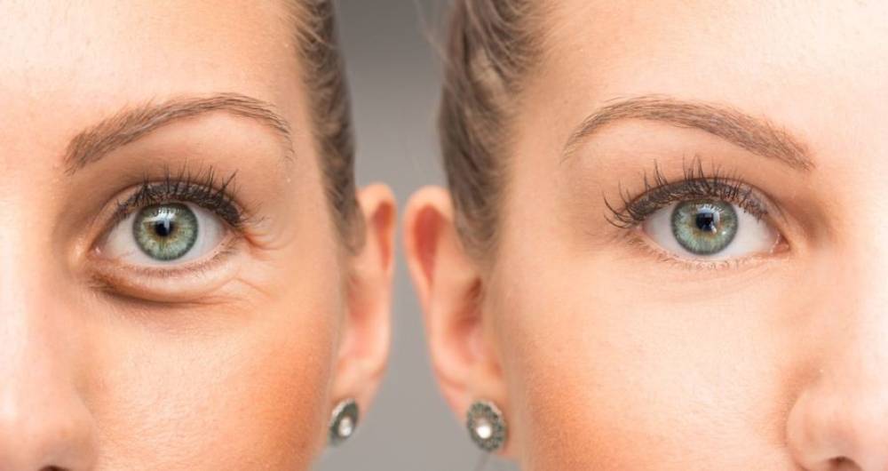 معرفی بهترین روش های درمان چین و چروک های زیر چشم+ مزایای آنها